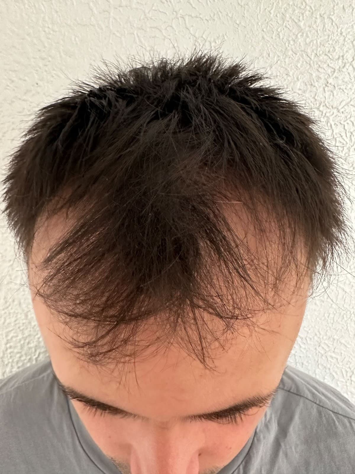 Sercan Aslan - Hair Transplant Turkey