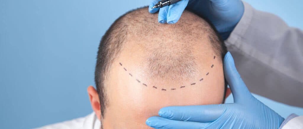 Antalya Hair Transplant in Turkey