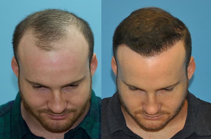Antalya Hair Transplant in Turkey