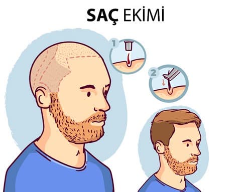 Antalya Hair Transplant in Turkey