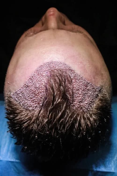 Antalya Hair Transplant in Turkey