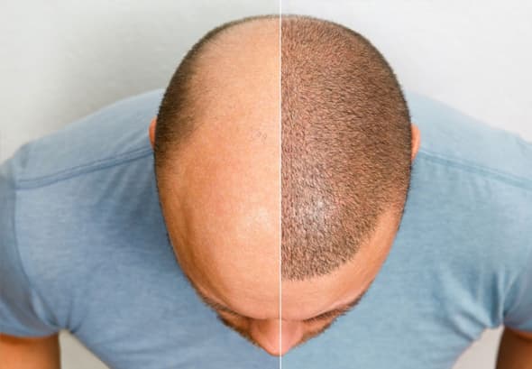 Antalya Hair Transplant in Turkey