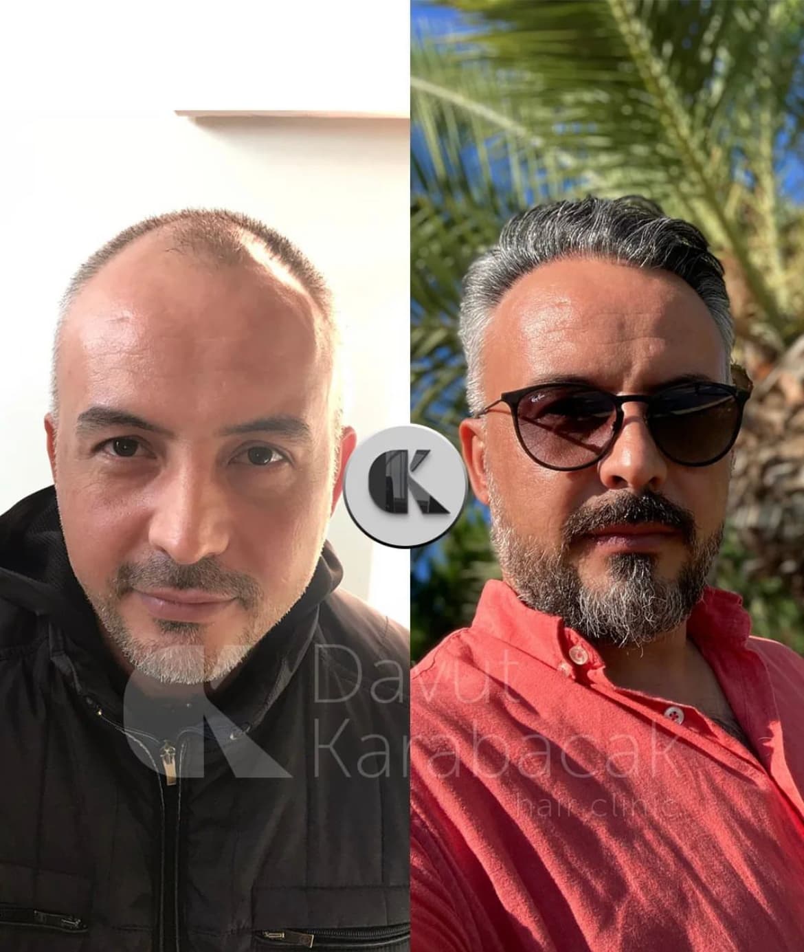 Davut Karabacak Hair Clinic Antalya / Saç PRP'si