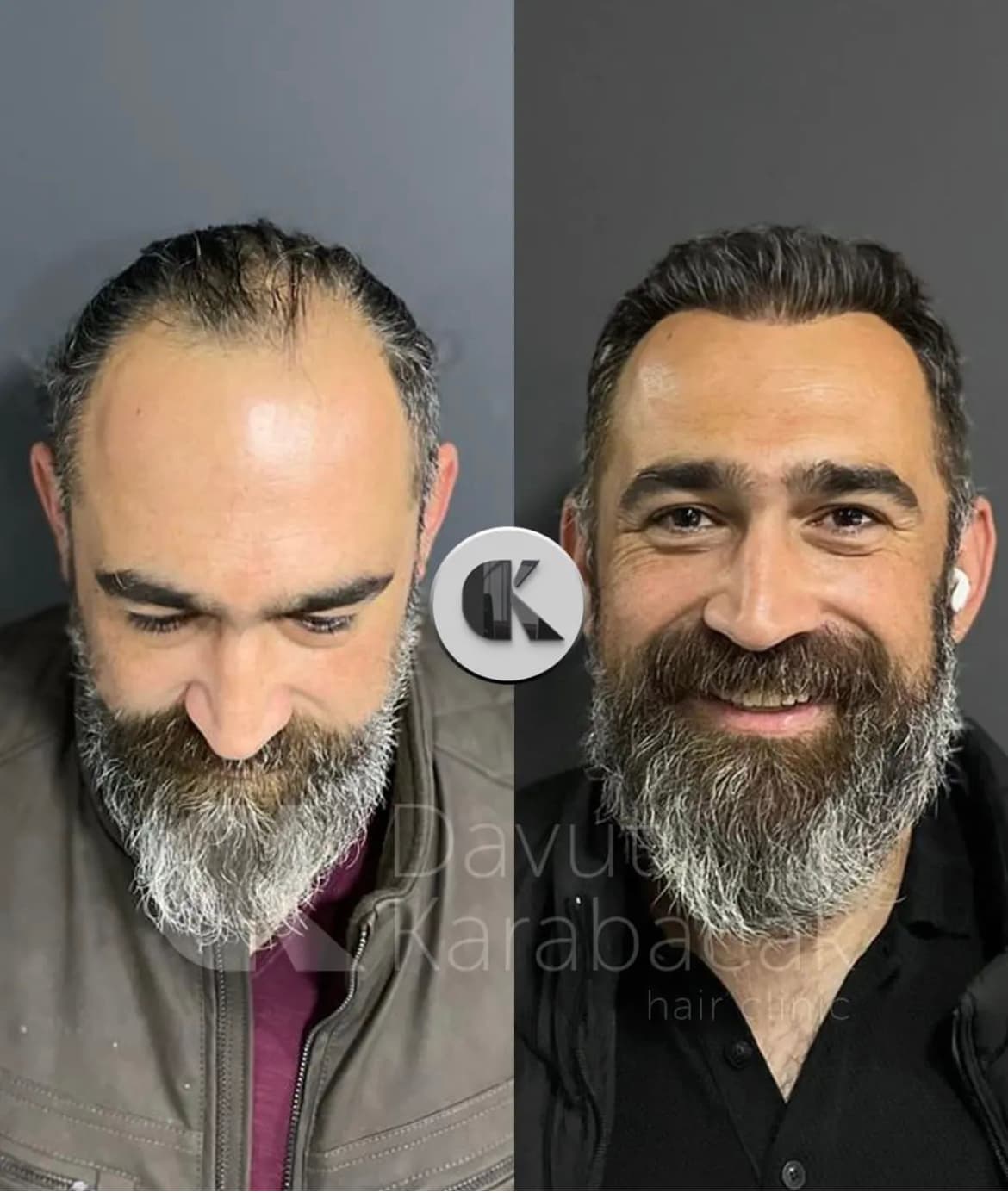 Davut Karabacak Hair Clinic Antalya / Saç PRP'si