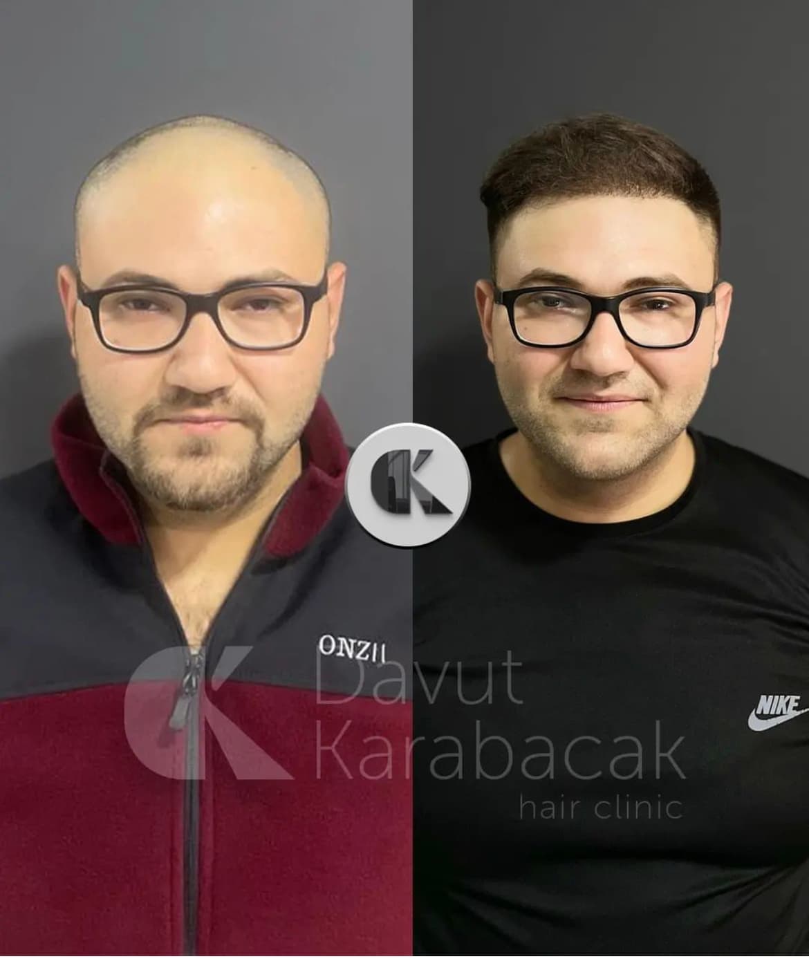 Davut Karabacak Hair Clinic Antalya / Saç PRP'si