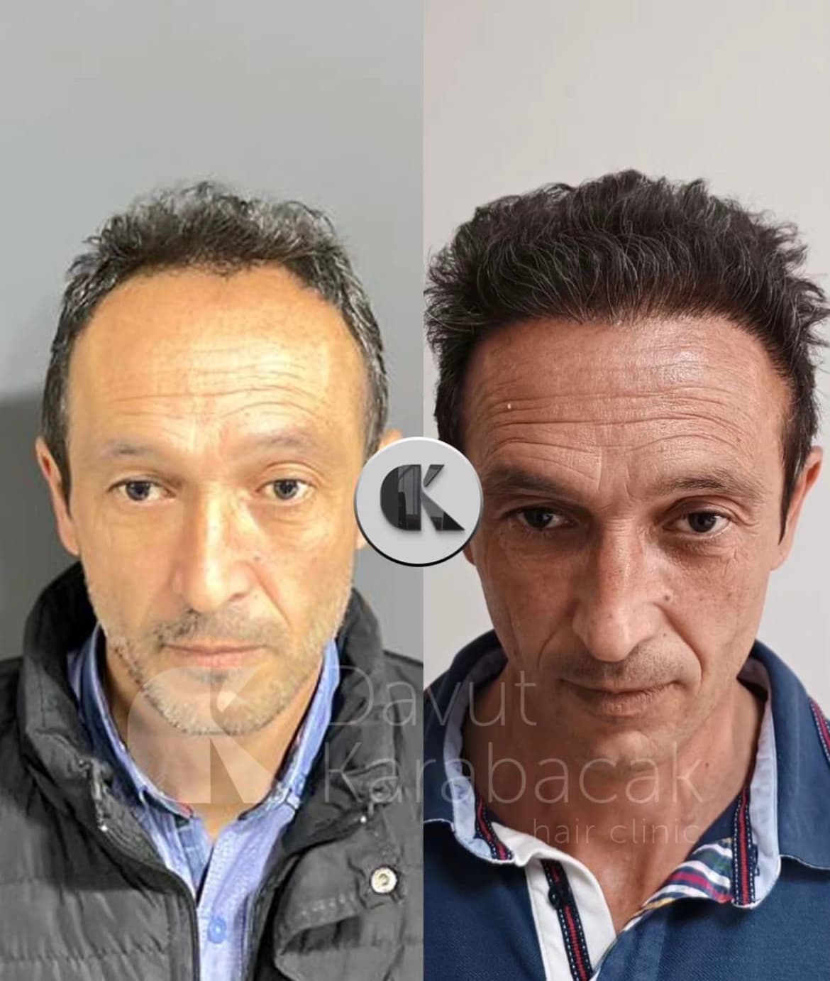 Davut Karabacak Hair Clinic Antalya / Saç PRP'si