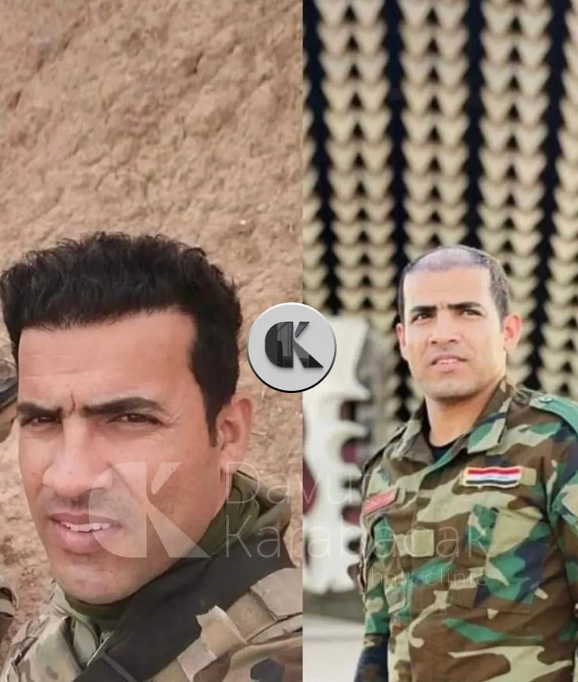 Davut Karabacak Hair Clinic Antalya / Saç PRP'si