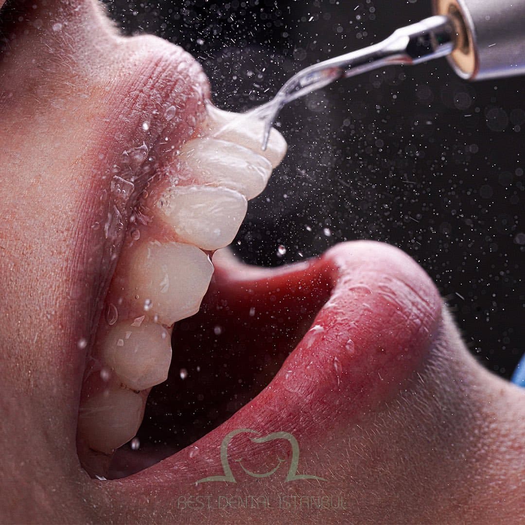 Best Dental İstanbul | Veneers | Implants | Crowns