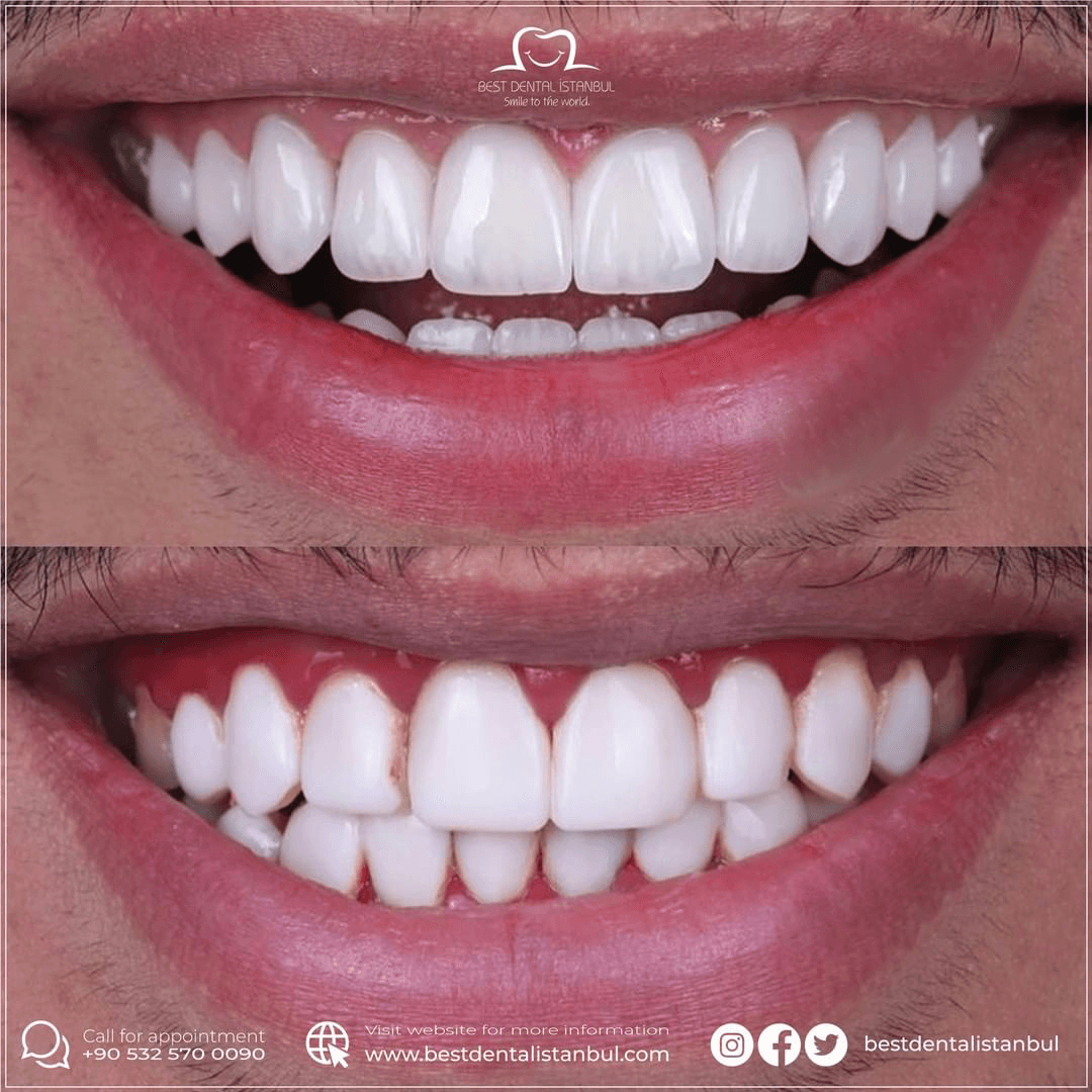 Best Dental İstanbul | Veneers | Implants | Crowns