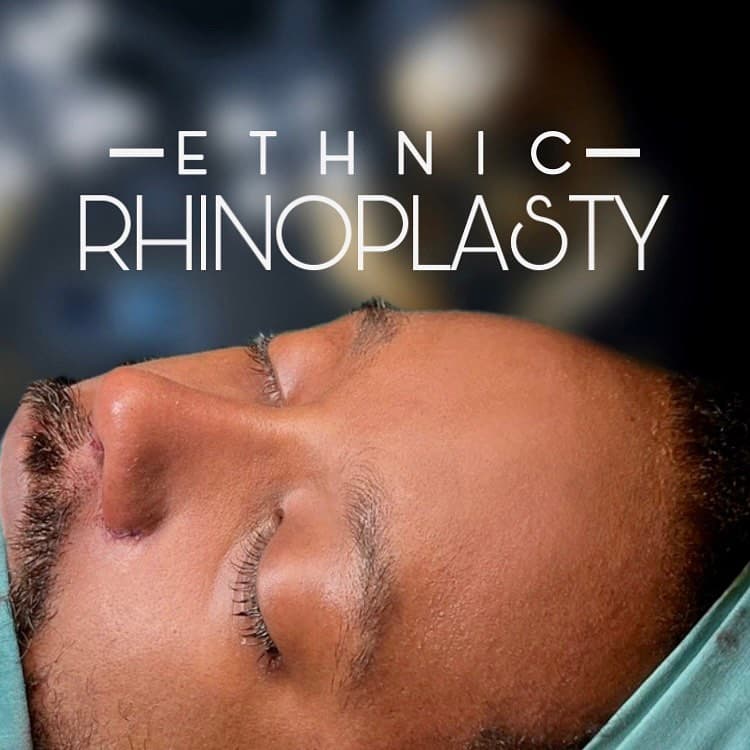 Ethnic Rhinoplasty