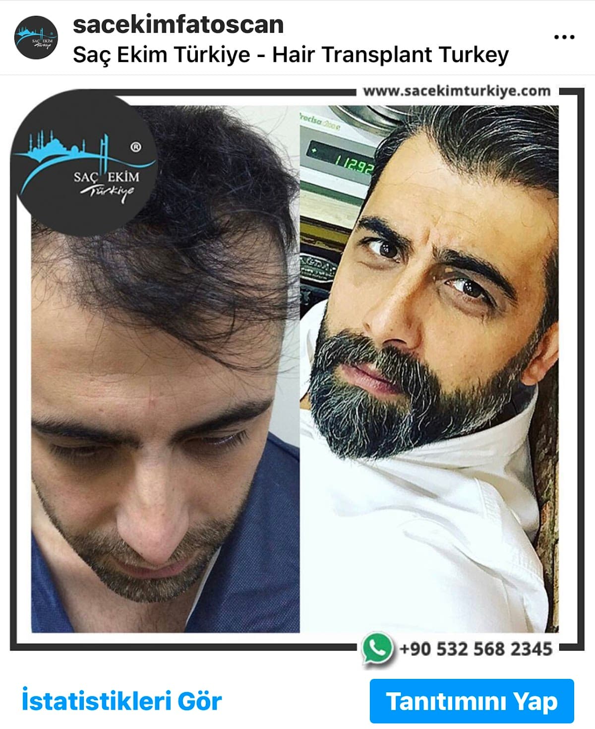 Saç ekimi Türkiye