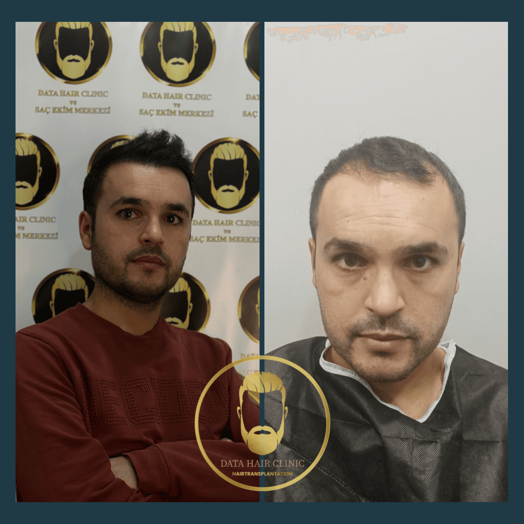 Data Hair Clinic & Eyyüp Tütüncü Saç Ekim Merkezi