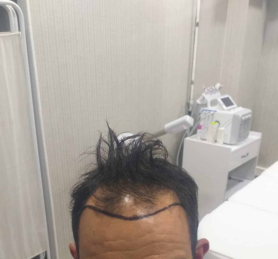 After Hair - Protez Saç Merkezi - Saç Ekim Kliniği