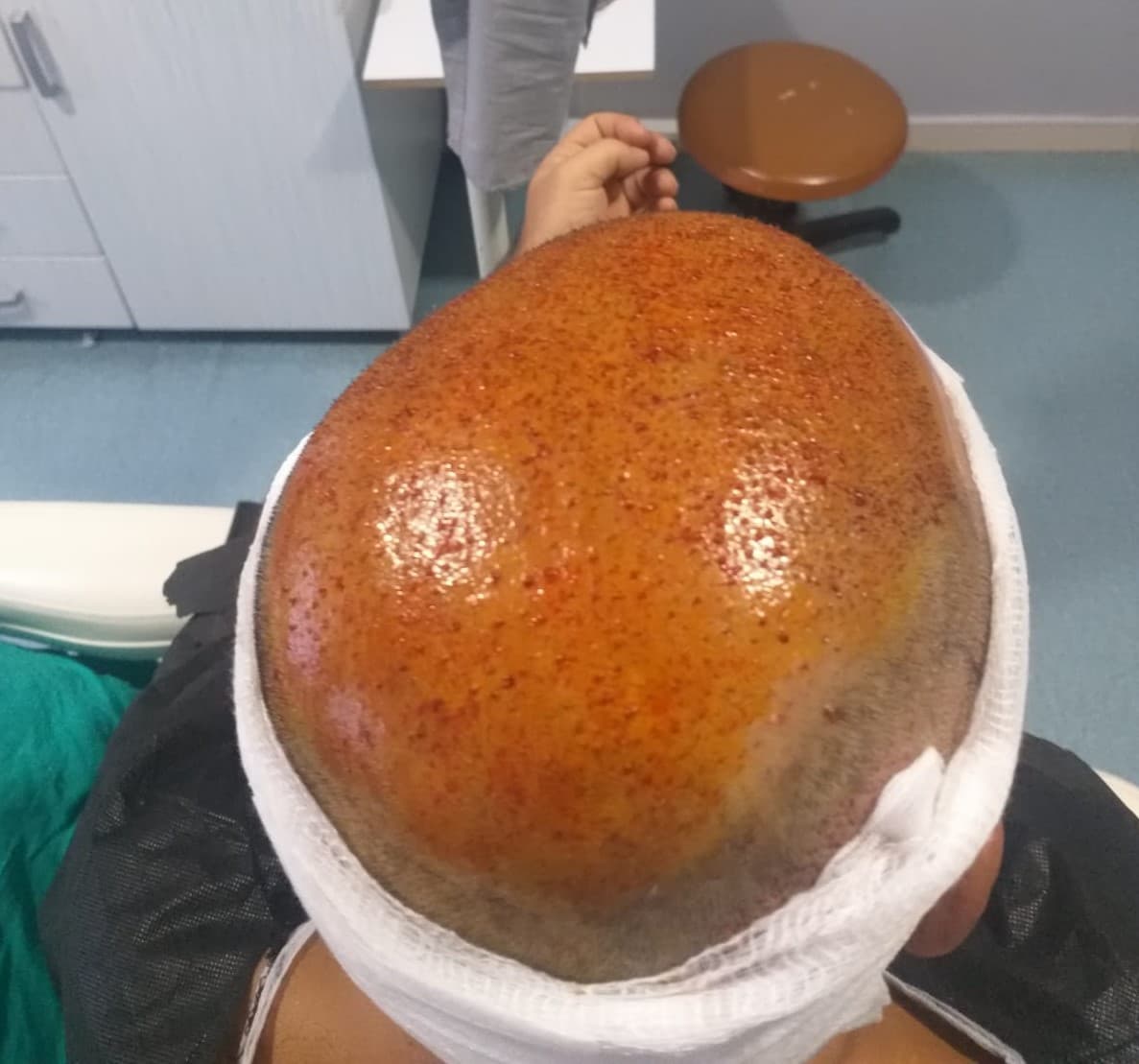 After Hair - Protez Saç Merkezi - Saç Ekim Kliniği