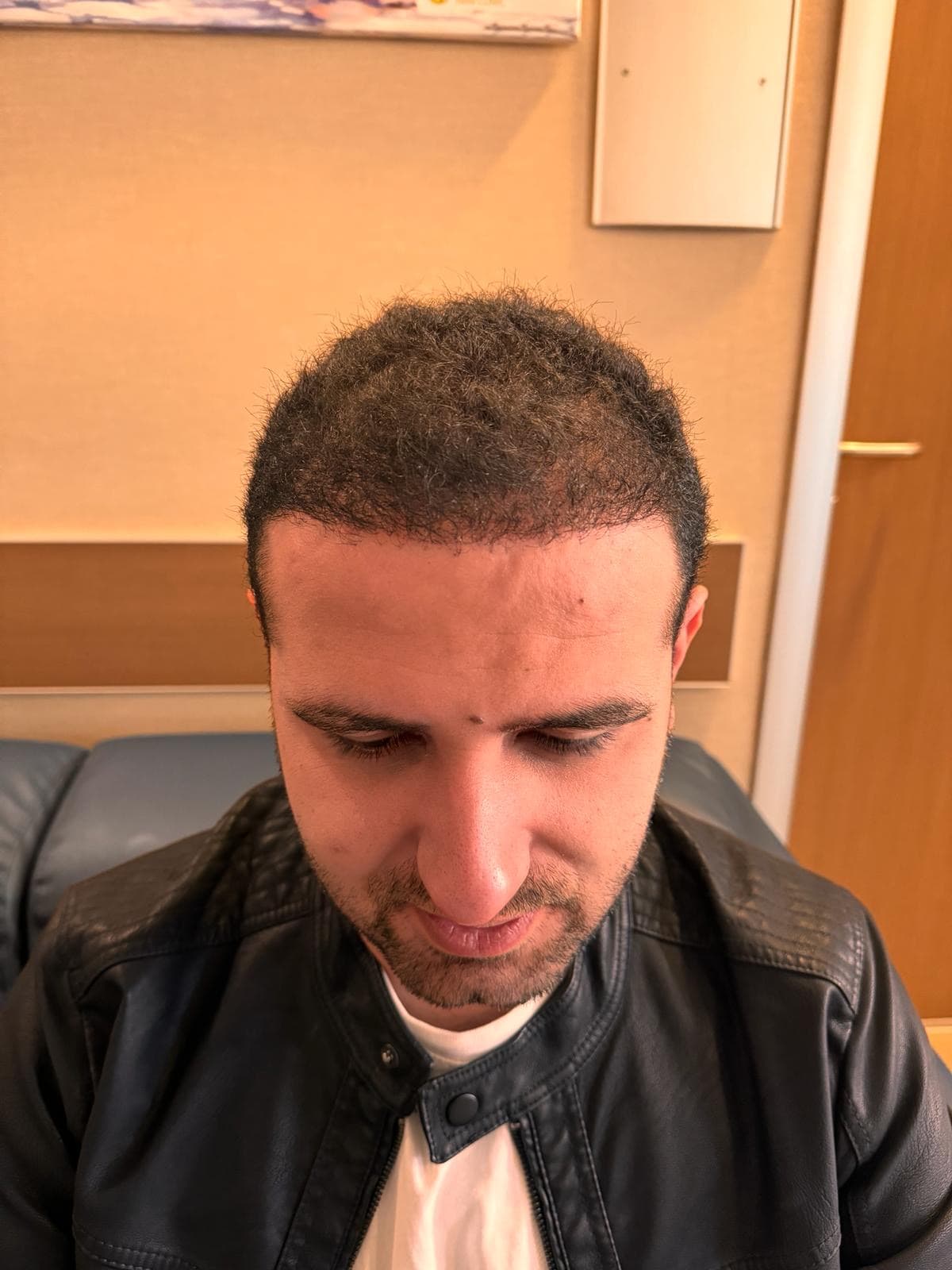 Bilyana Hair Transplant