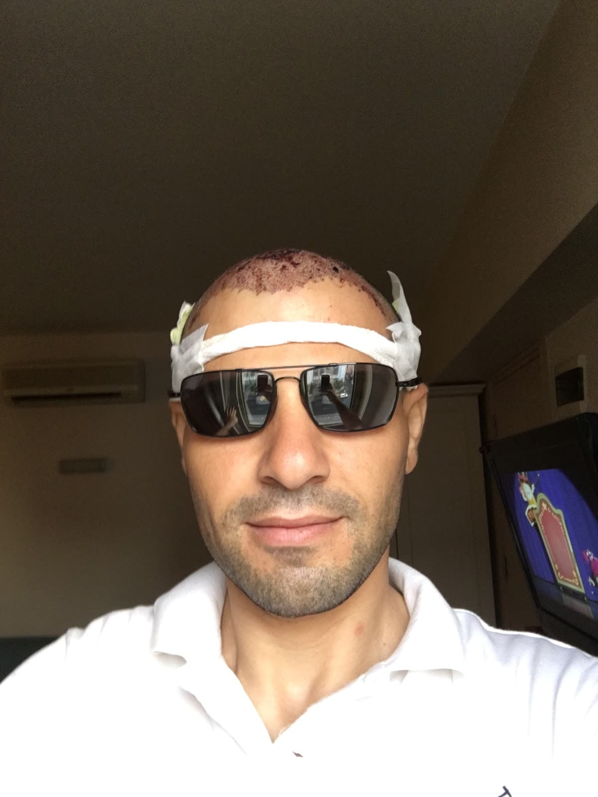 Infinity Hair Transplant In Turkey