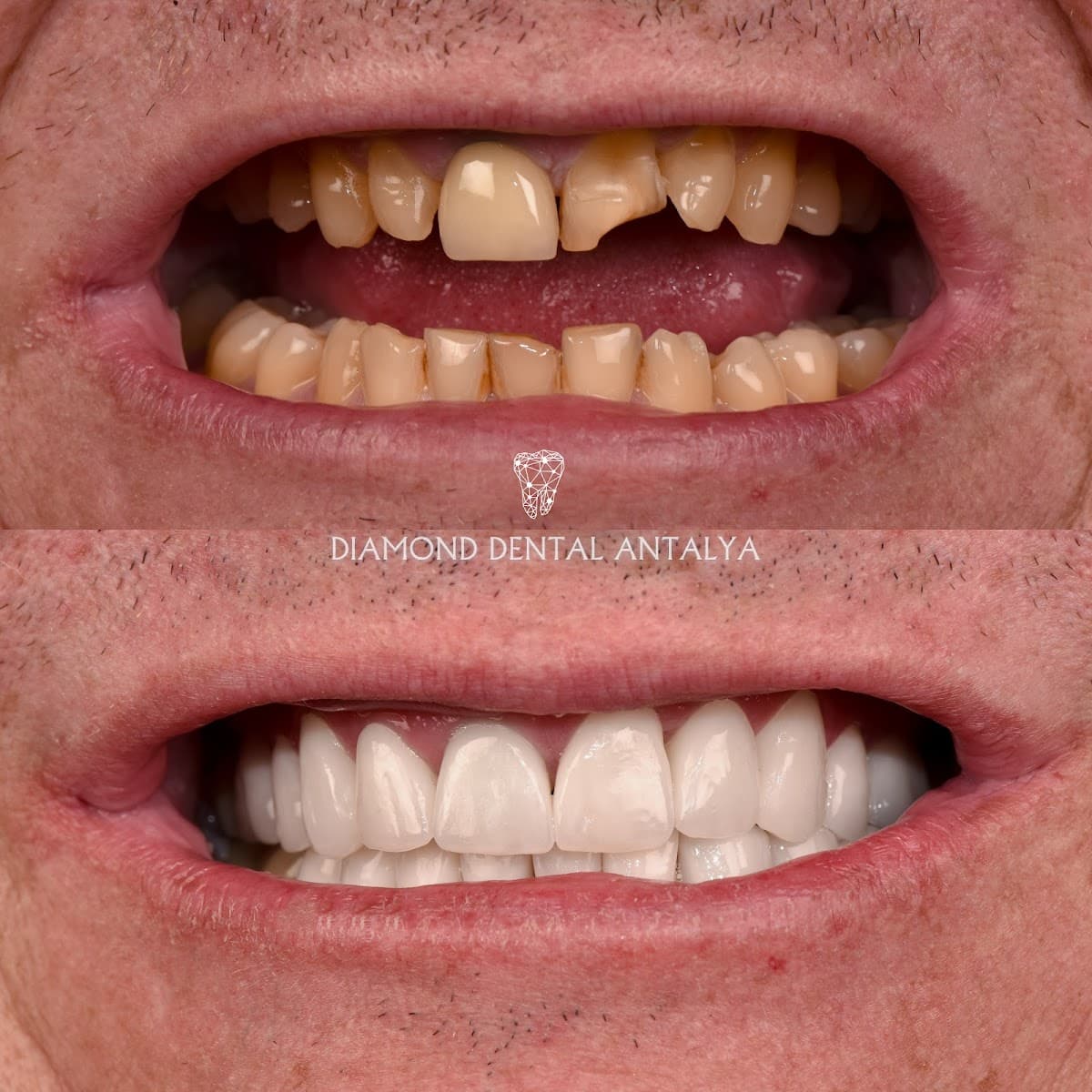 Diamond Dental Antalya