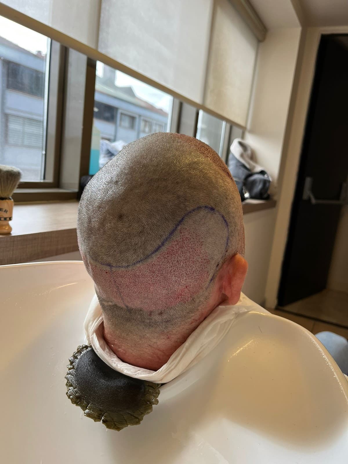 EsteNove - Best Hair Transplant in Turkey