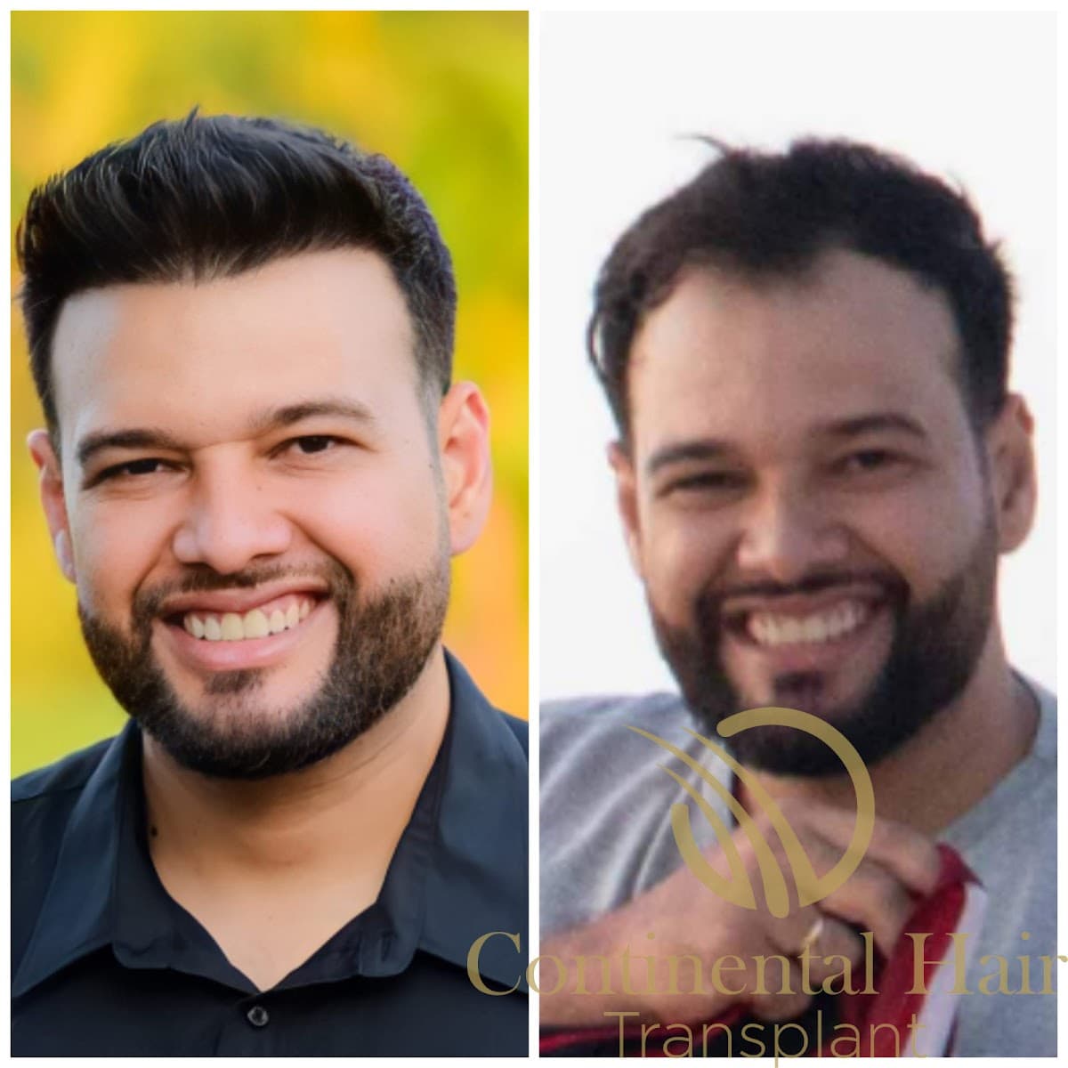 Continental Hair Transplant Istanbul