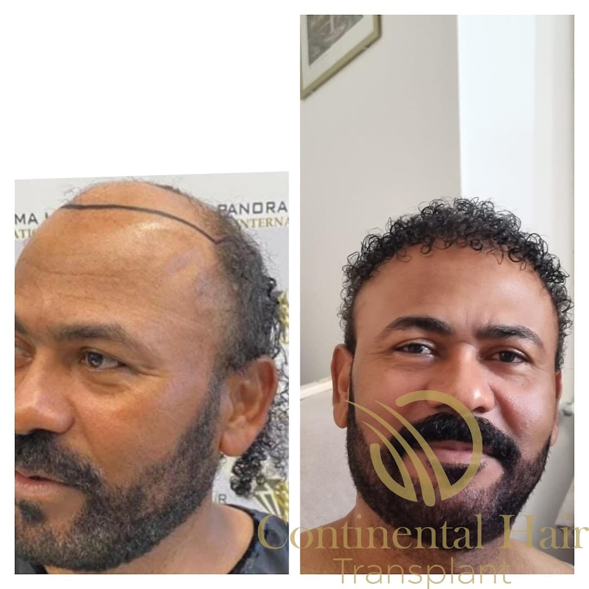 Continental Hair Transplant Istanbul