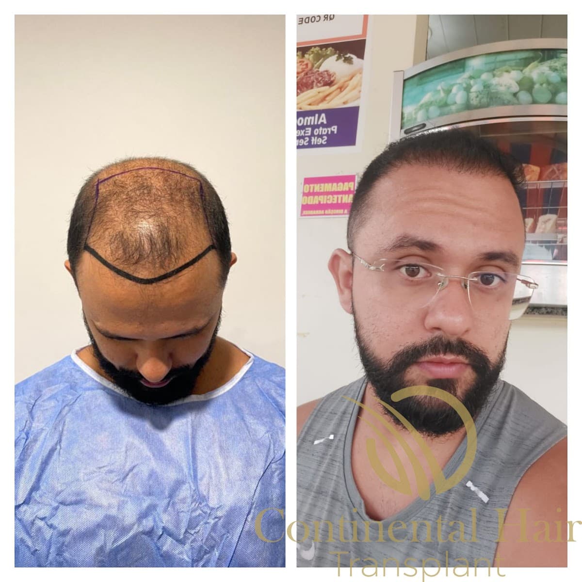 Continental Hair Transplant Istanbul
