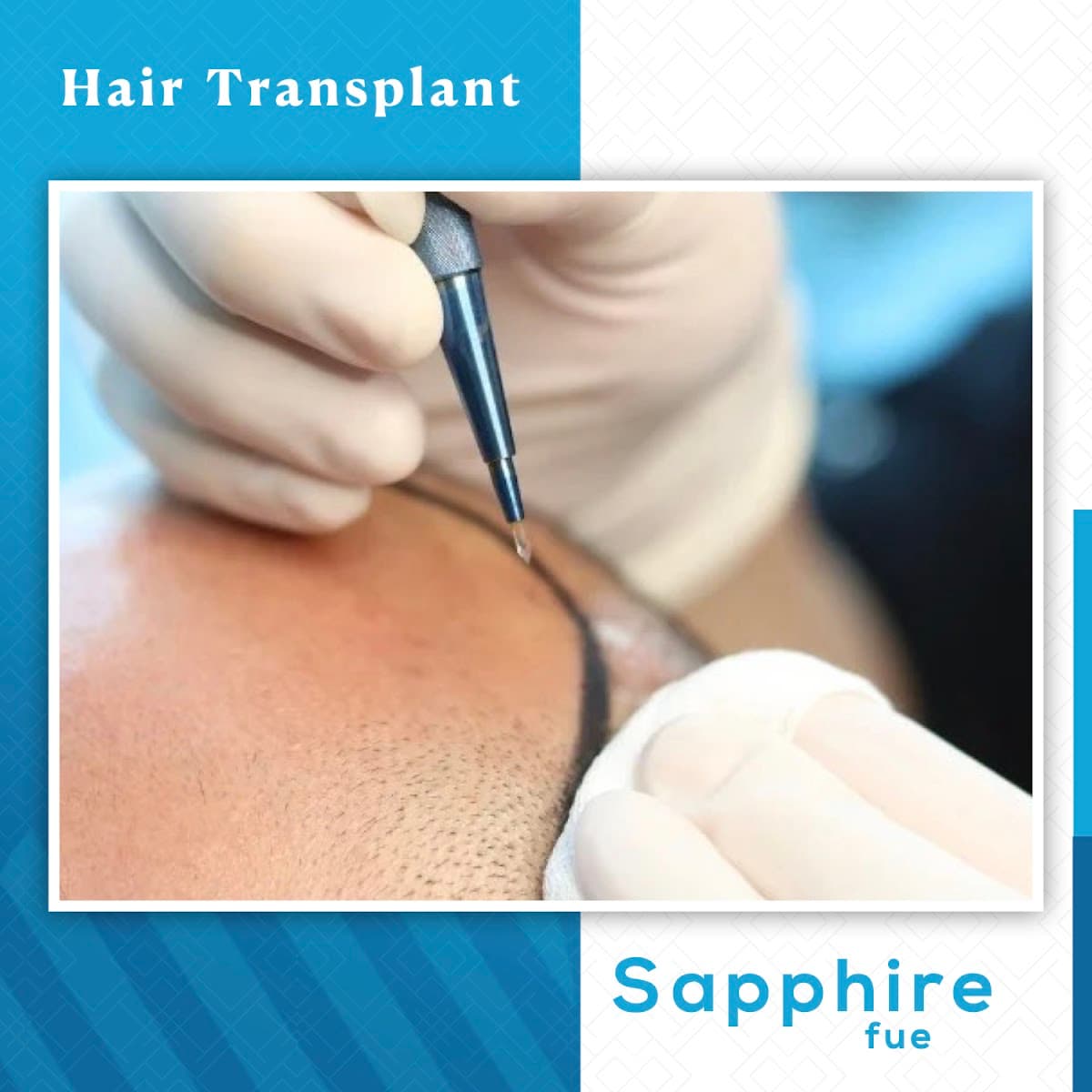 زراعة الشعر في تركيا اسطنبول - INF.Clinic Turkey