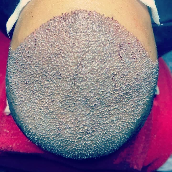 زراعة الشعر في تركيا اسطنبول - INF.Clinic Turkey