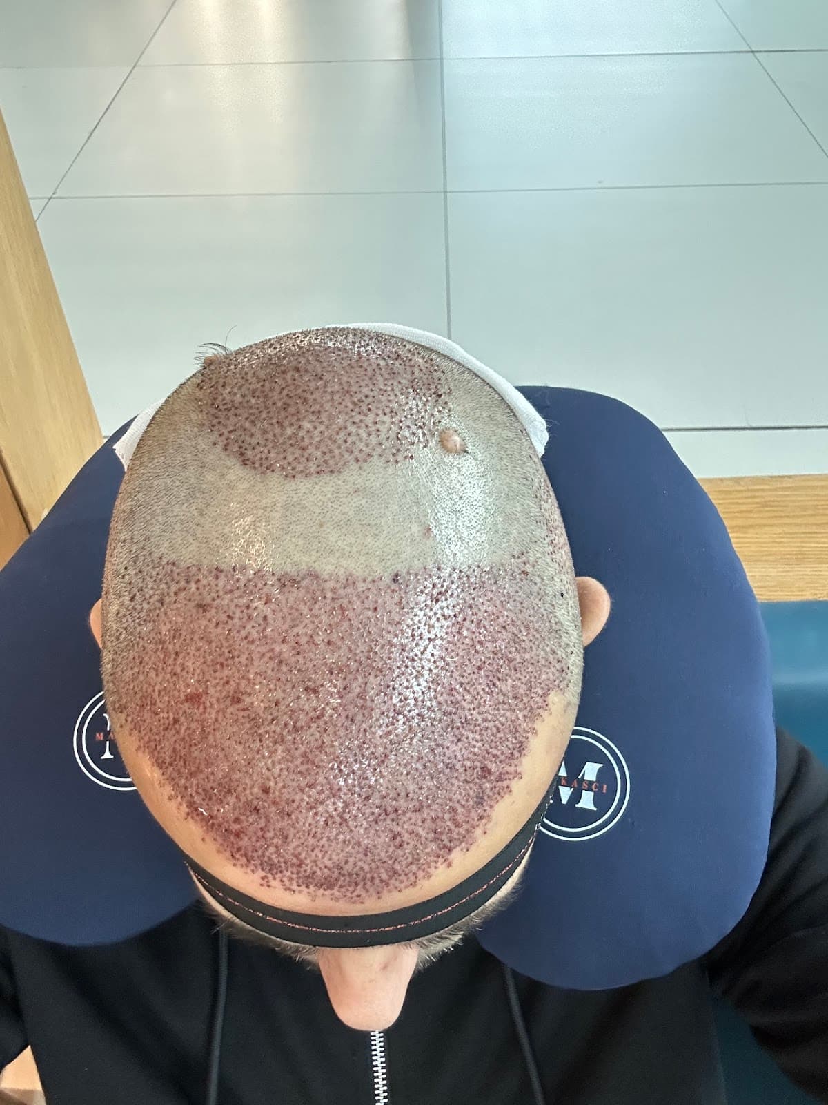 Özel Murat Makascı Polikliniği - Saç Ekimi