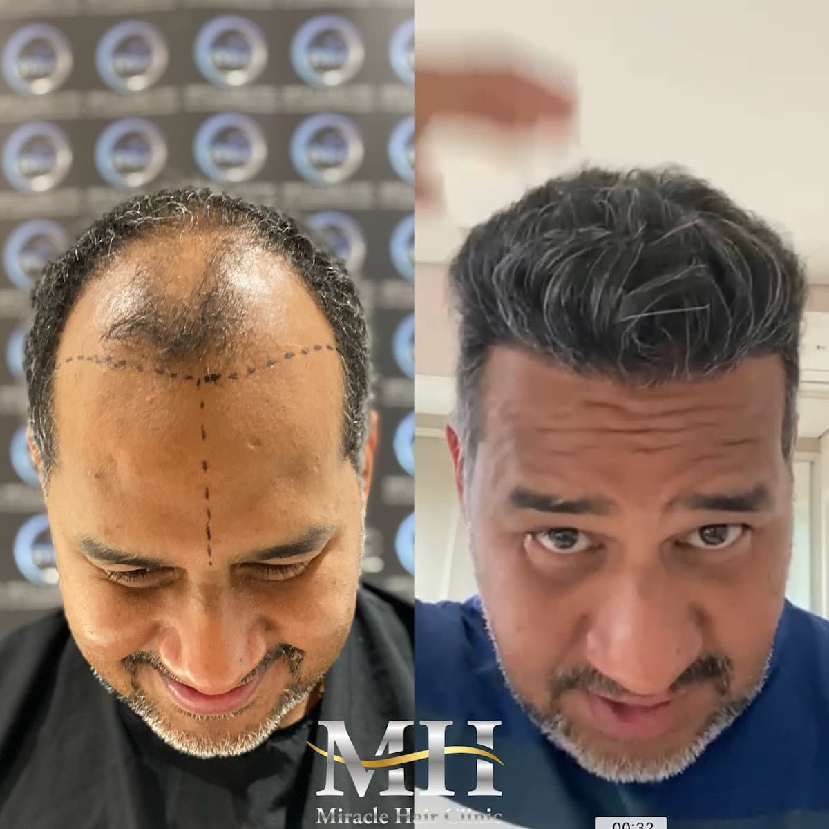 Miracle Hair Clinic Hair Transplant Turkey