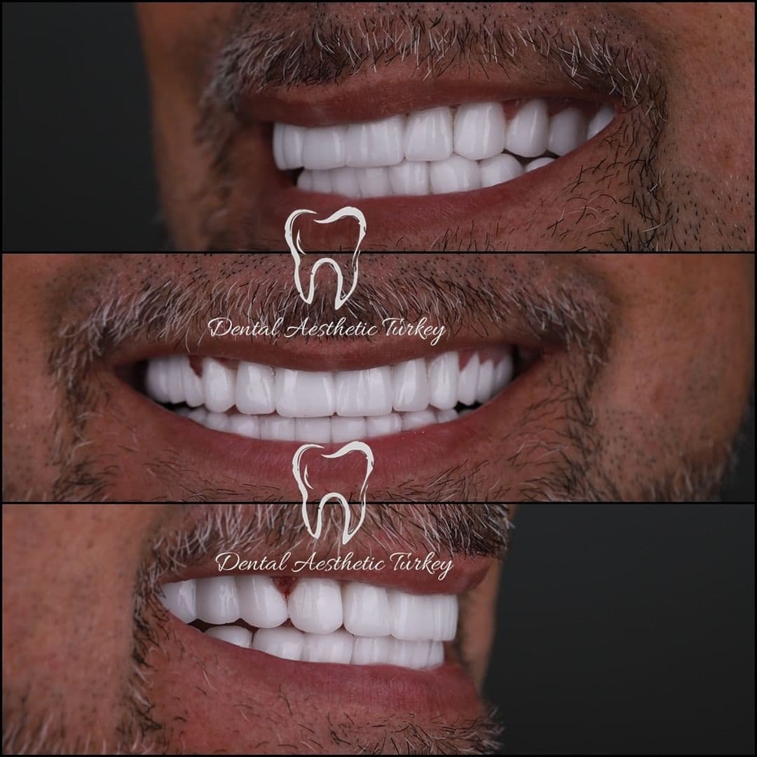 Dental Aesthetic Turkey