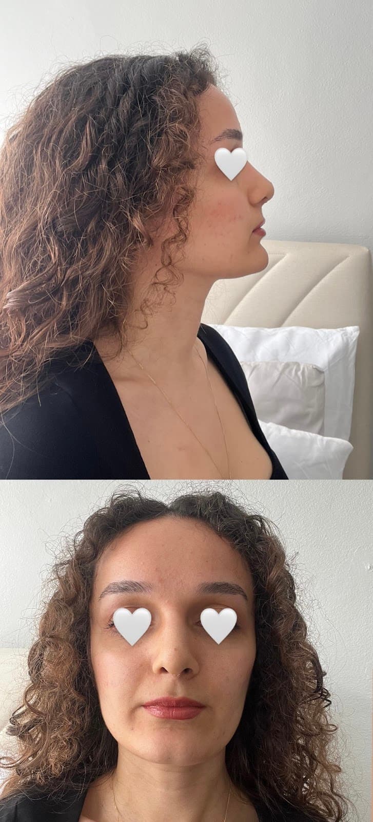 Burun Estetiği Merkezi İSTANBUL-Op. Dr. Cem ALTINDAĞ