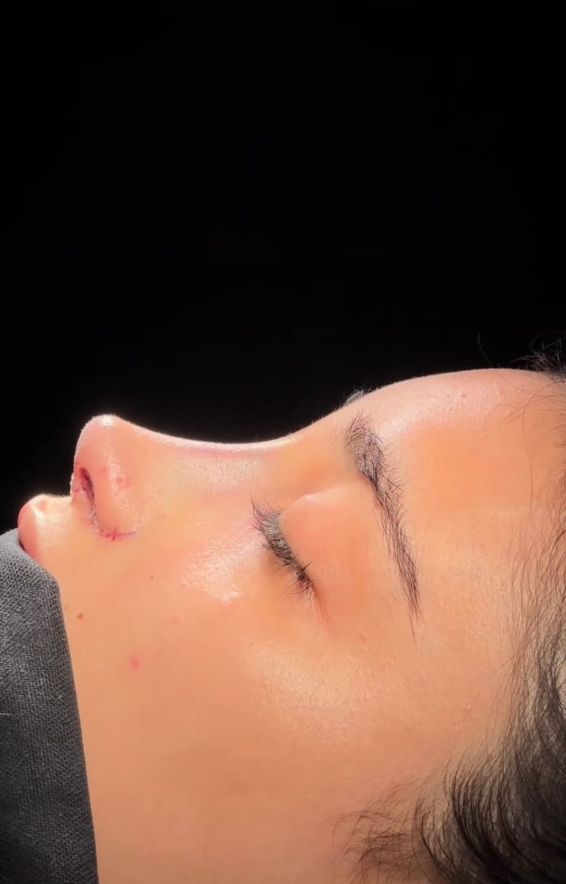 Op. Dr. Nazlı Selvi | Burun Estetiği - KBB Ameliyatları