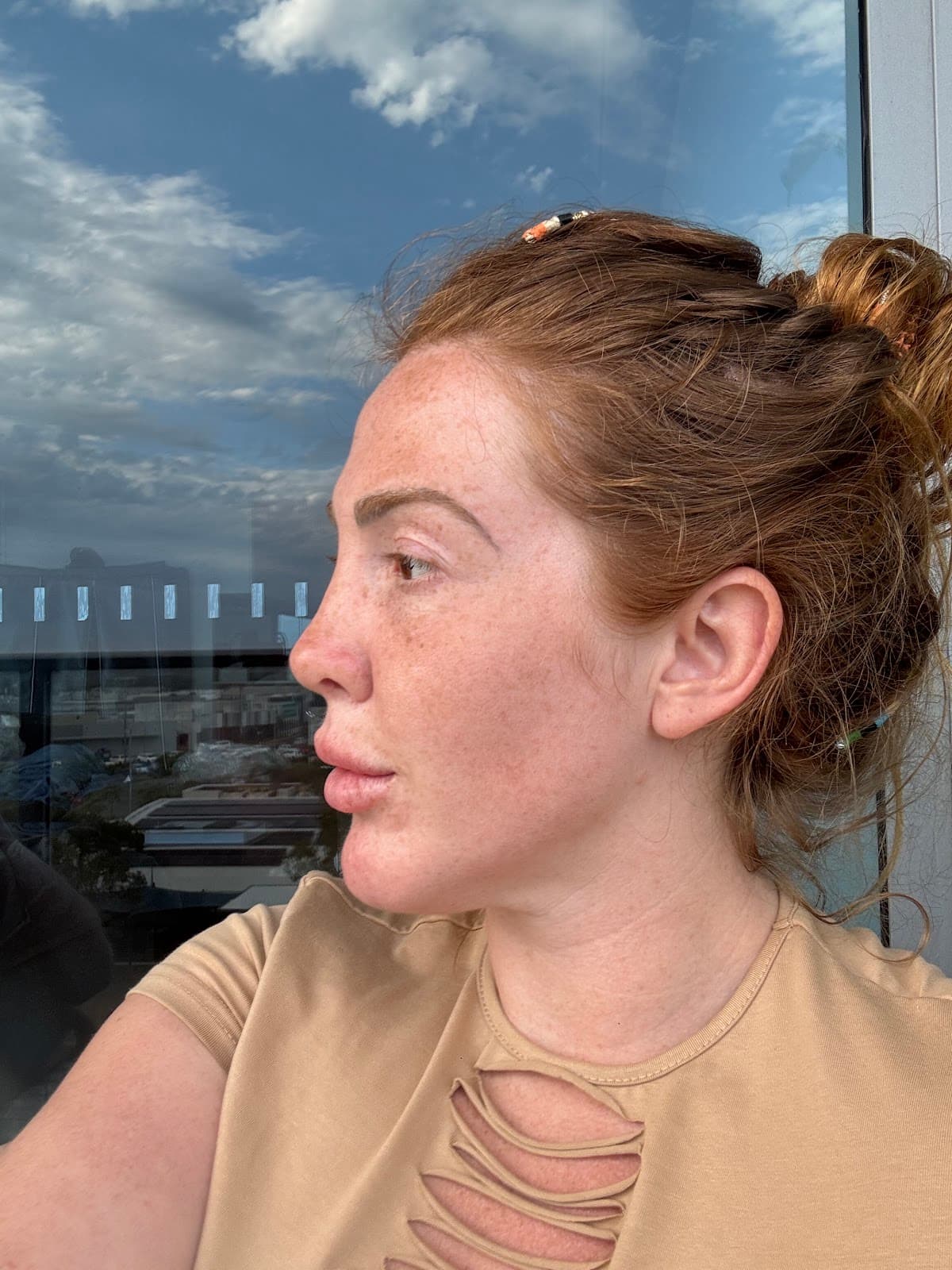 Op. Dr. Nazlı Selvi | Burun Estetiği - KBB Ameliyatları