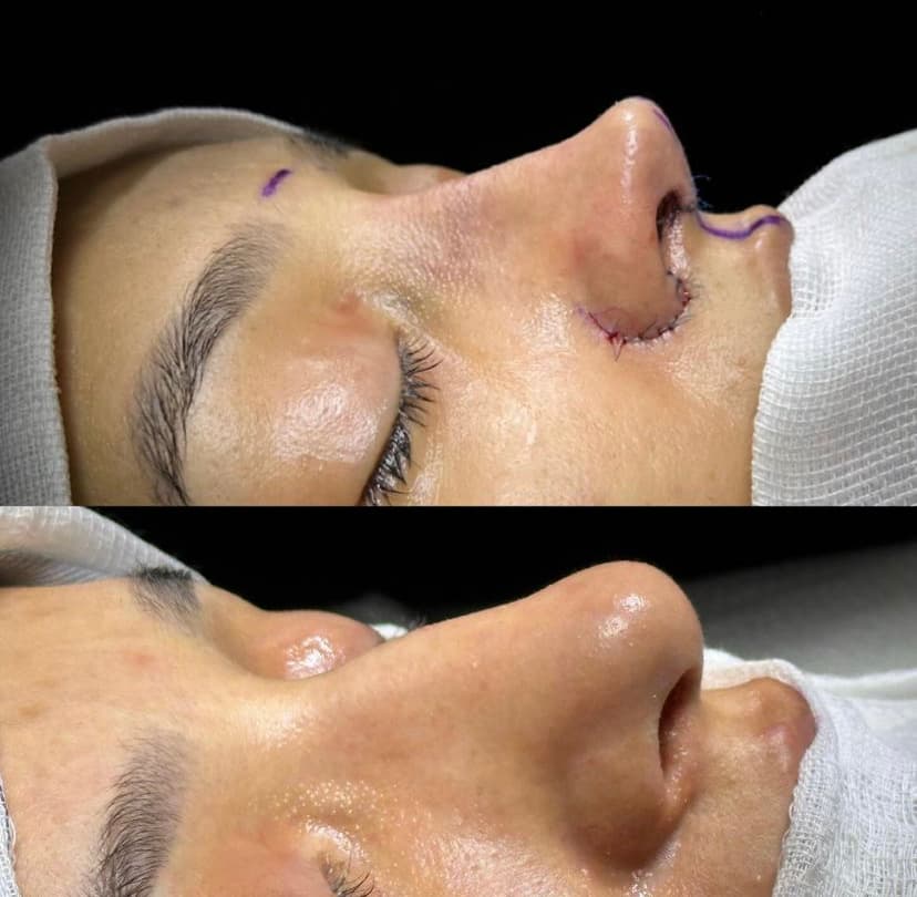 OP.DR.CEVDET MURAT AKAGÜN Burun estetiği ANKARA