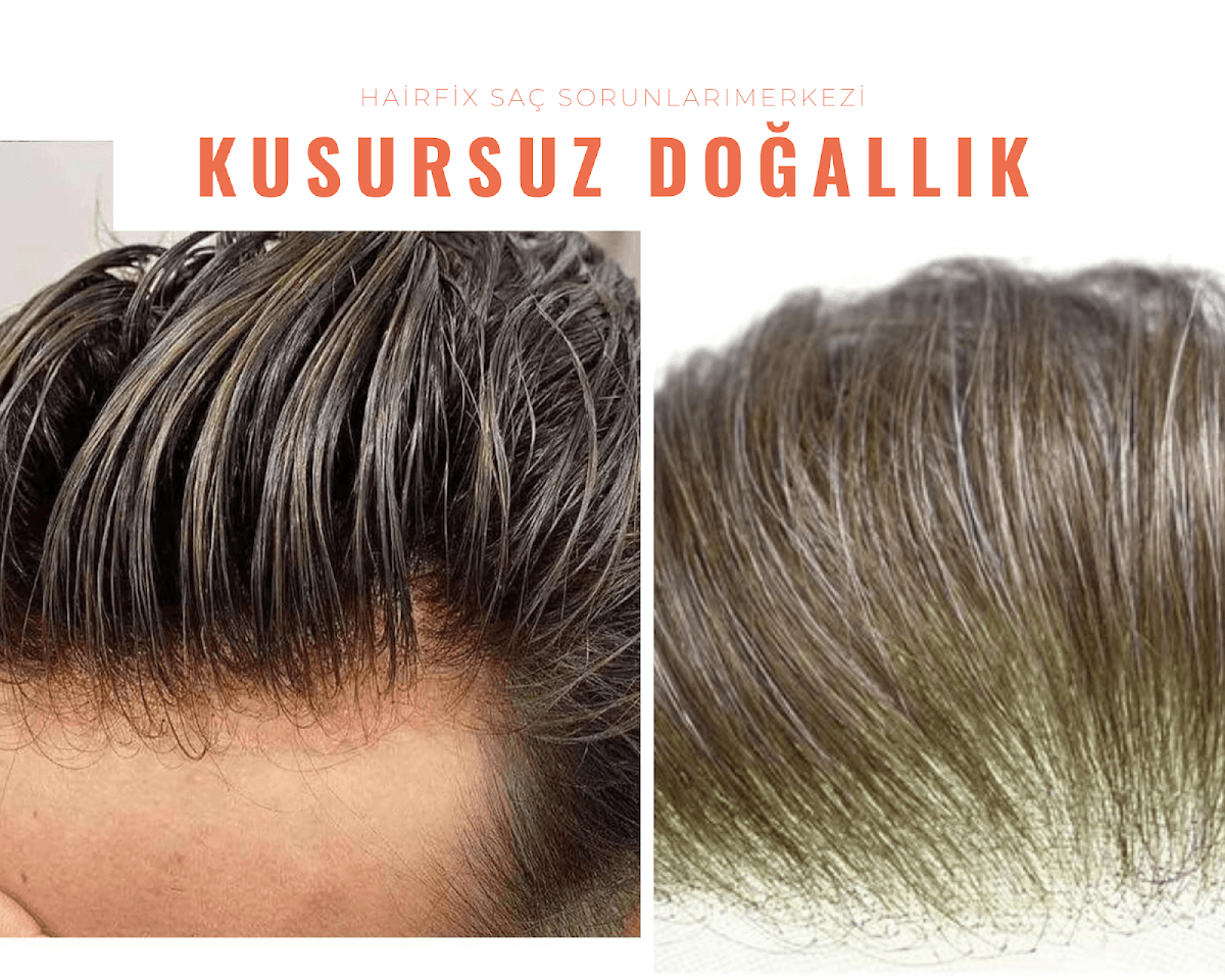 YUKA HAİRFİX HAIR PROSTHESES