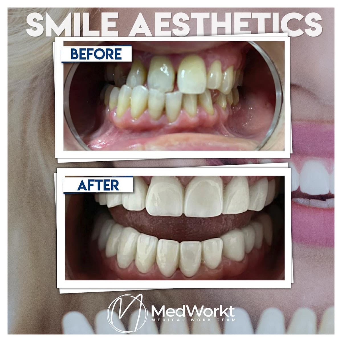 Mommy Makeover - Tummy Tuck - Breast Lift - Liposuction