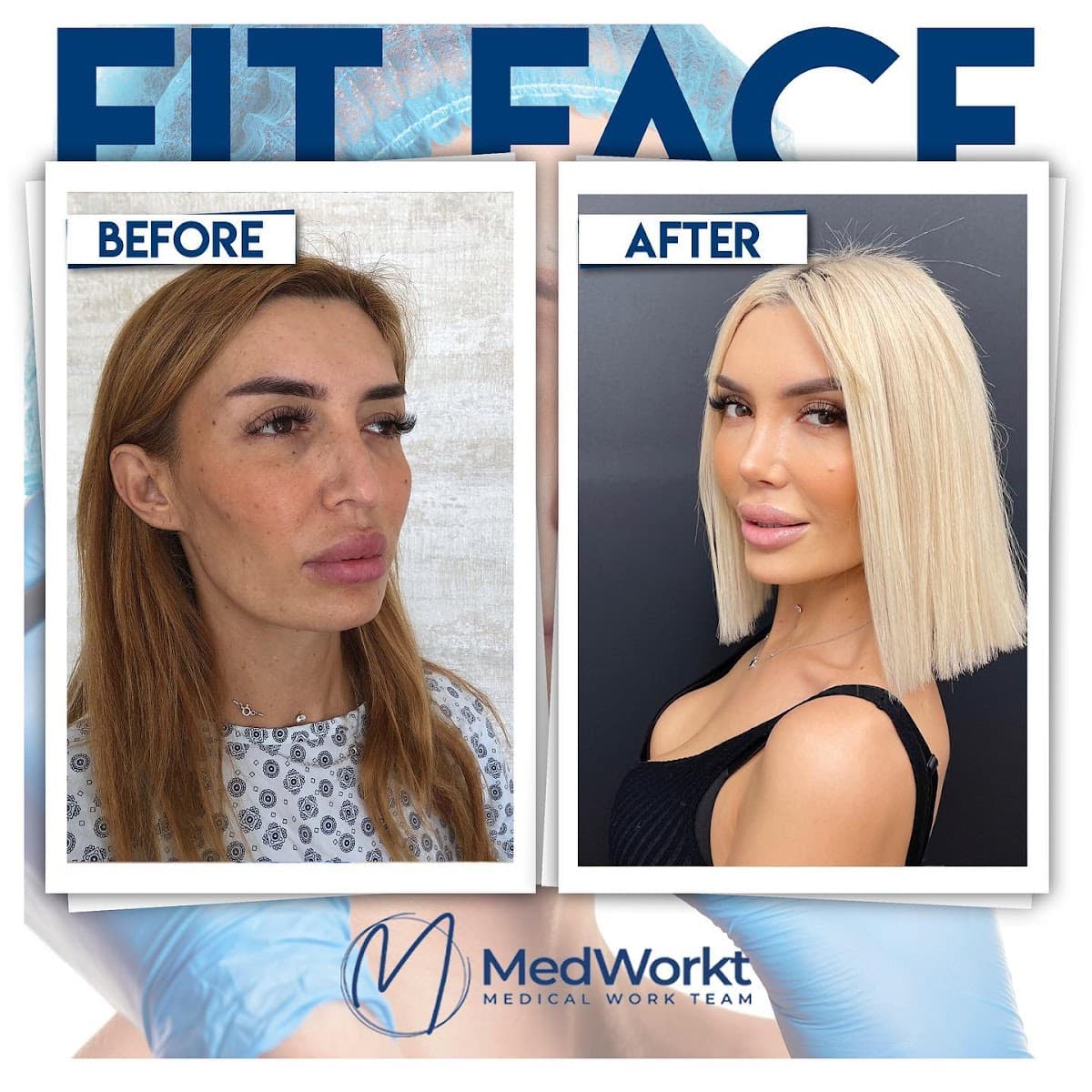 Mommy Makeover - Tummy Tuck - Breast Lift - Liposuction