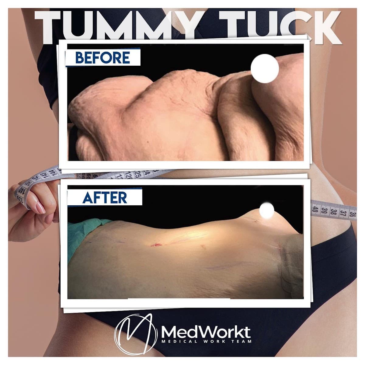 Mommy Makeover - Tummy Tuck - Breast Lift - Liposuction