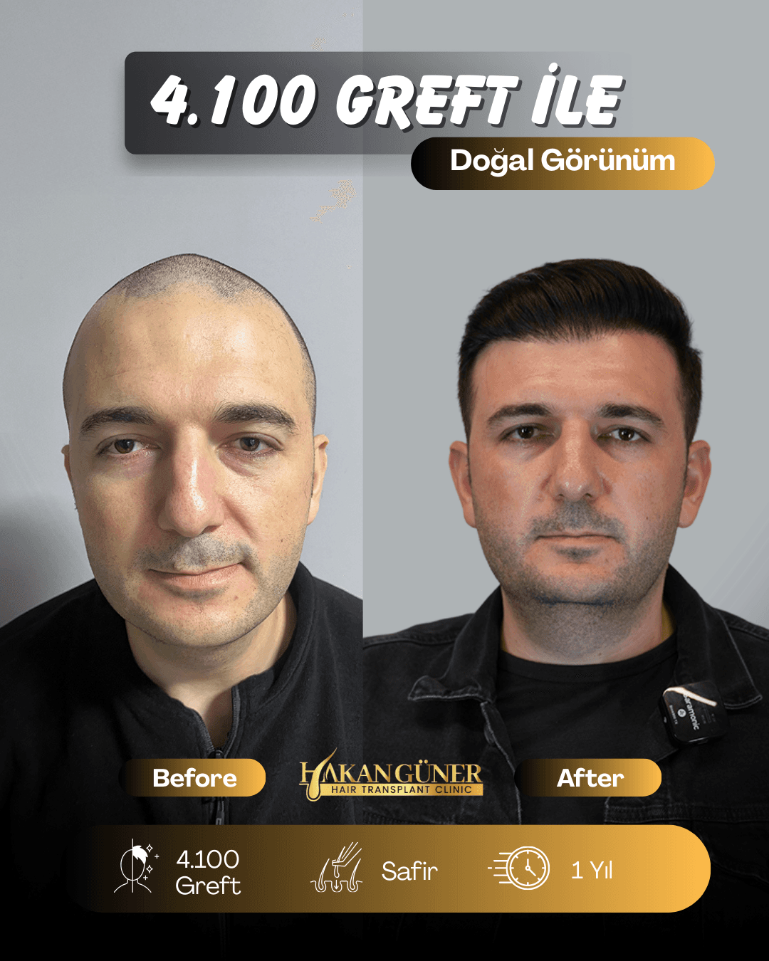 İzmir Saç Ekimi Merkezi - Hakan Güner