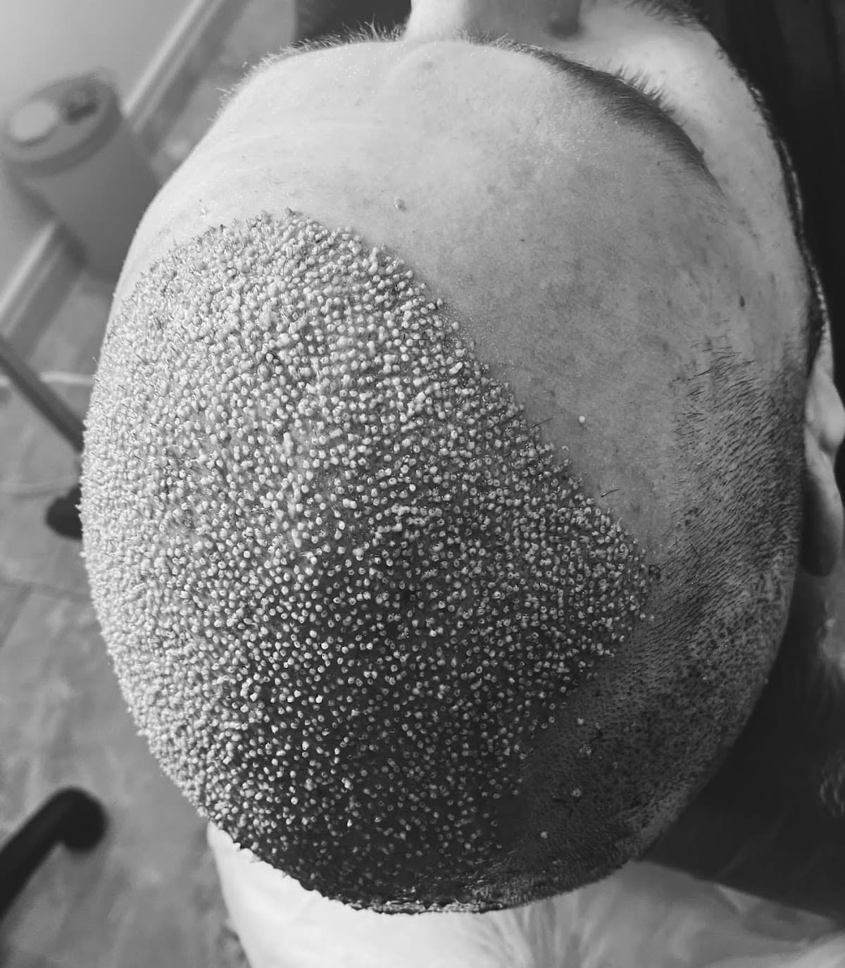 Bayraklı Saç Ekim Merkezi - İzmir Eges Hair Transplant