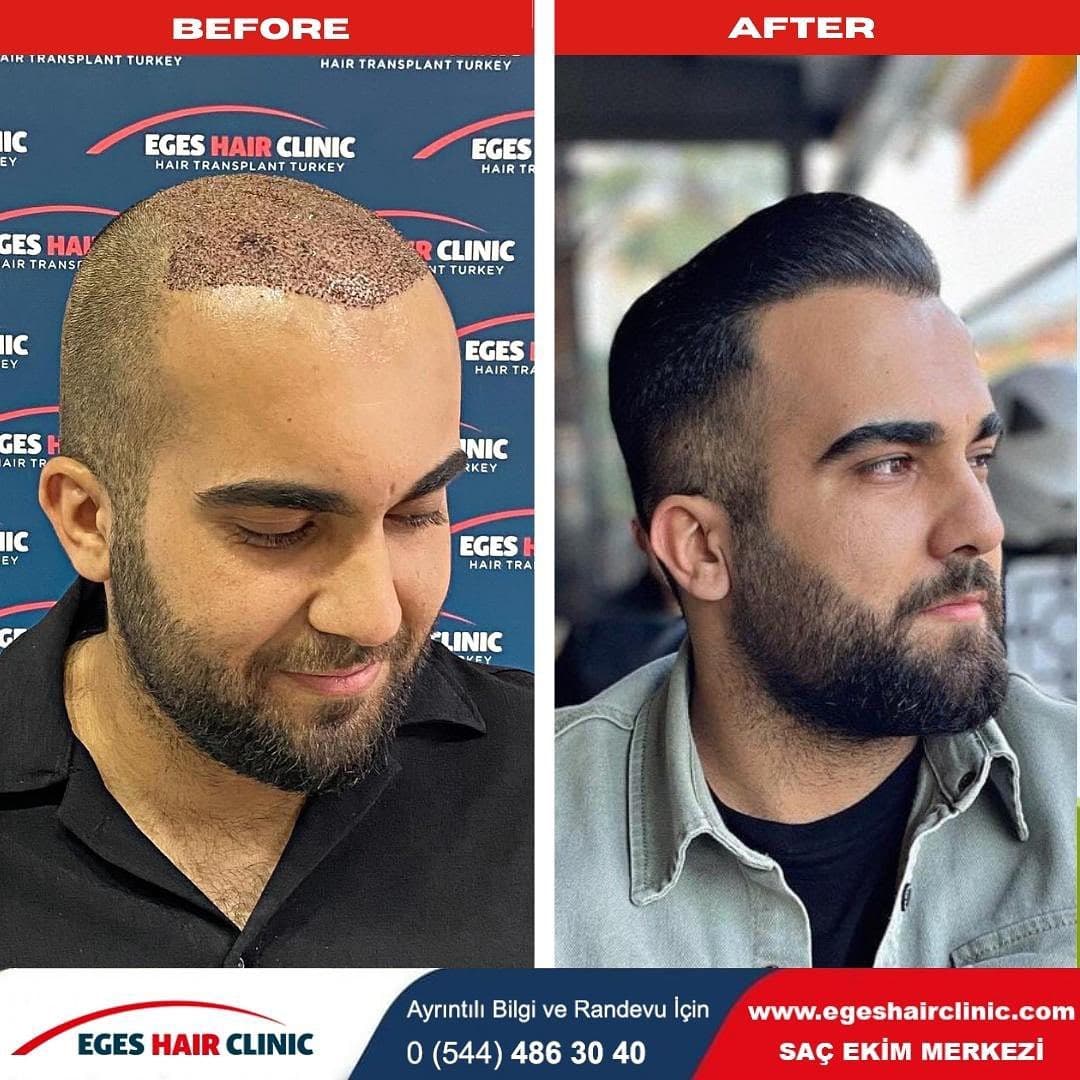 Bayraklı Saç Ekim Merkezi - İzmir Eges Hair Transplant