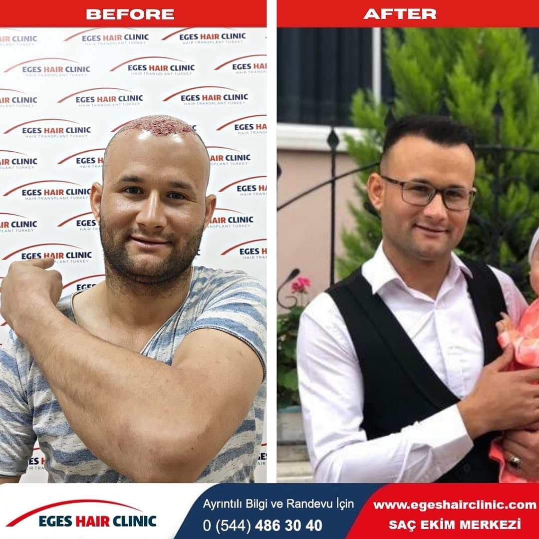 Bayraklı Saç Ekim Merkezi - İzmir Eges Hair Transplant