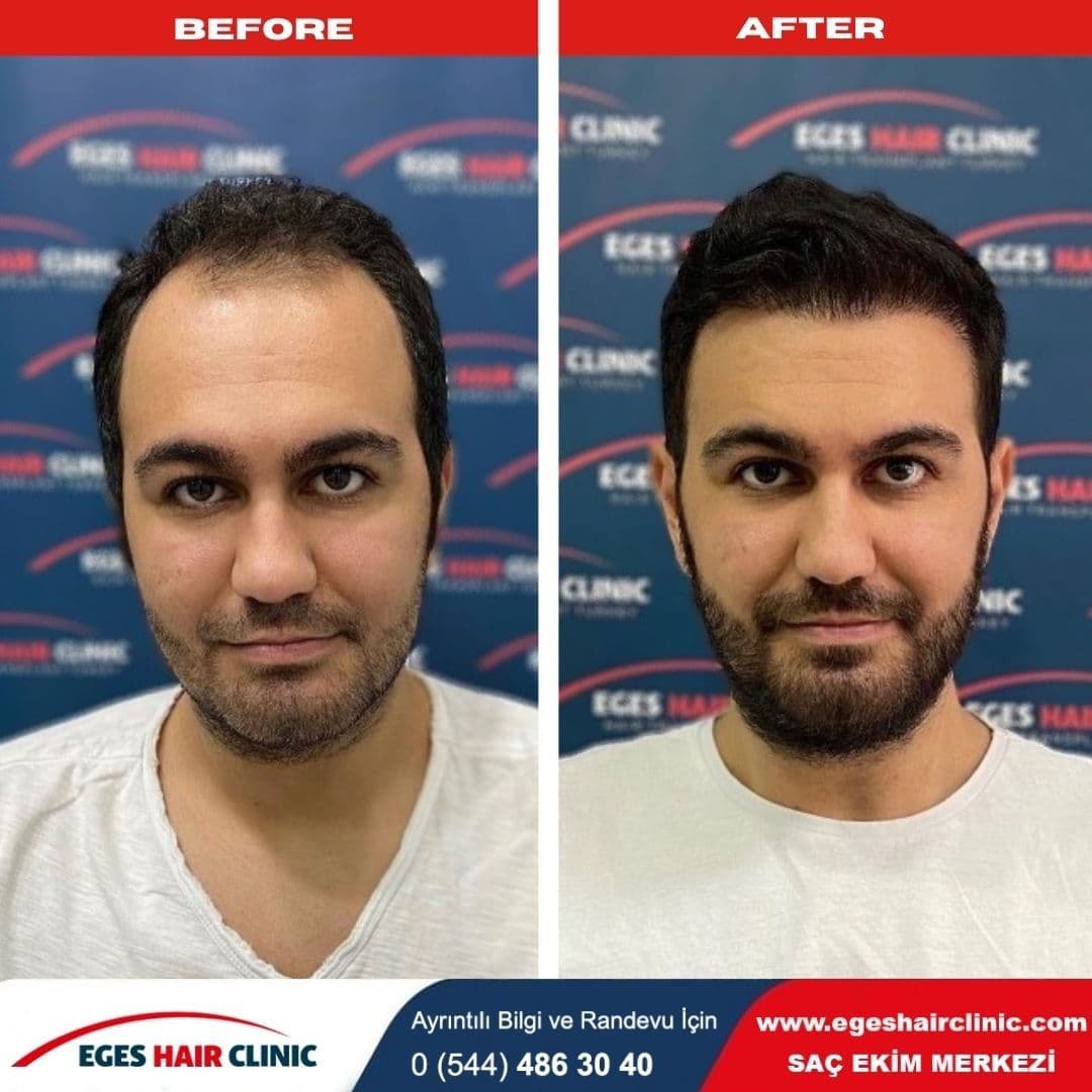 Bayraklı Saç Ekim Merkezi - İzmir Eges Hair Transplant