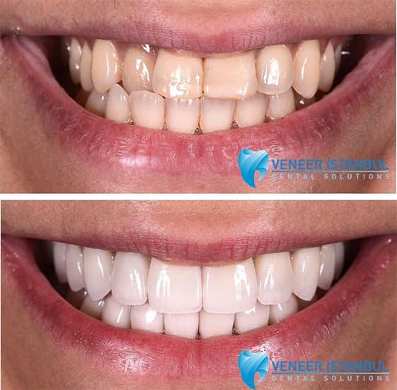 VeneerIstanbul.com.tr