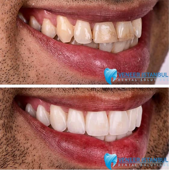 VeneerIstanbul.com.tr