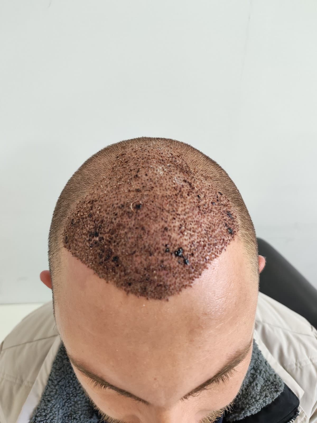 Erna Hair Clinic İzmir Saç Ekim Merkezi