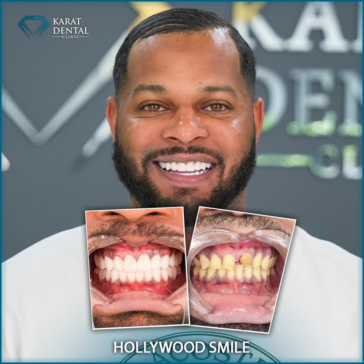 Karat Dental Clinic Turkey | Dental implants turkey | Implants dentaires Turquie