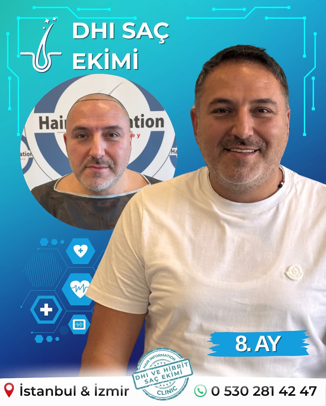 Hair Information Clinic - Saç Ekimi