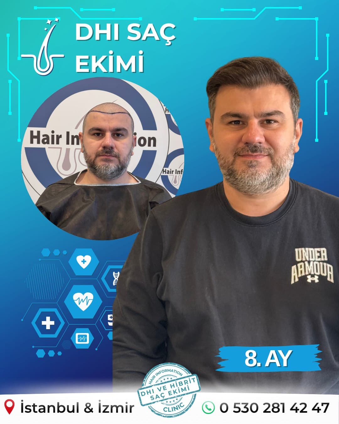 Hair Information Clinic - Saç Ekimi