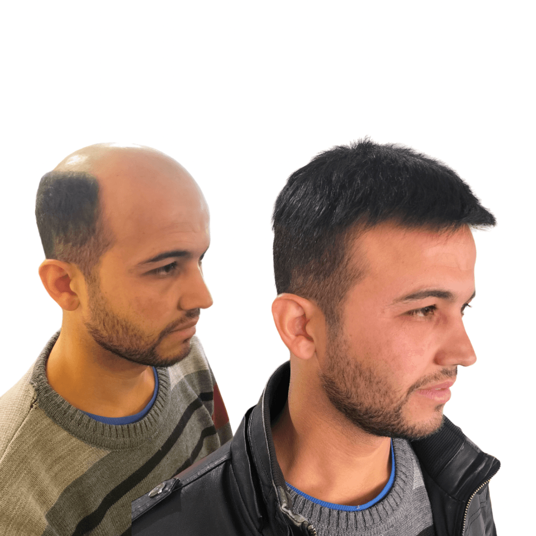 10 Hair İzmir Protez Saç
